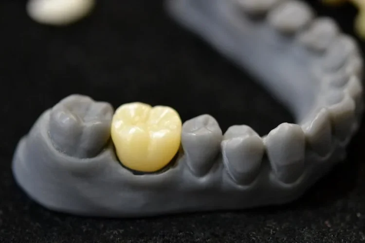 چاپ سه‌ بعدی دندان و کاربرد در ایمپلنت‌های سفارشی