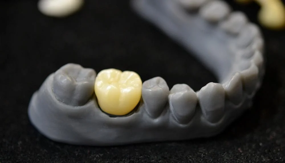 چاپ سه‌ بعدی دندان و کاربرد در ایمپلنت‌های سفارشی