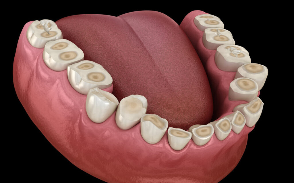 براکسیسم (دندان‌قروچه)