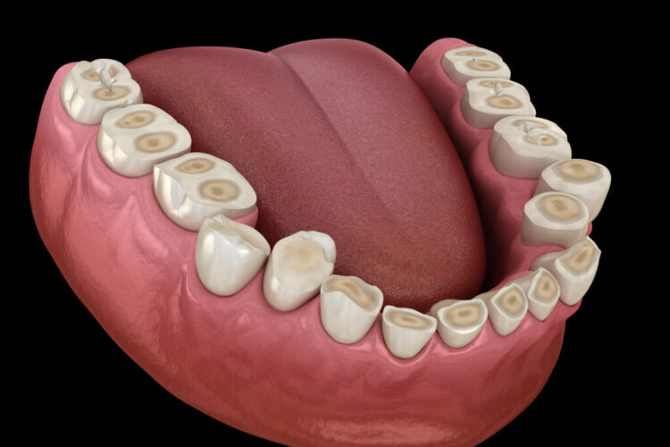 براکسیسم (دندان‌قروچه)