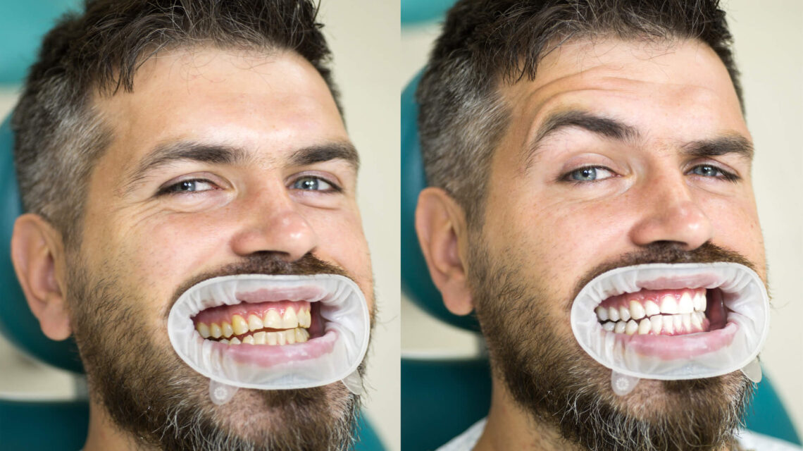 بلیچینگ دندان