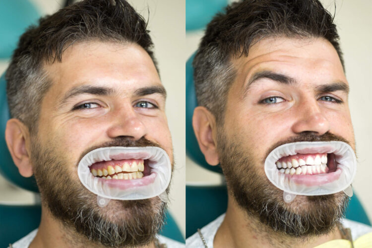 بلیچینگ دندان